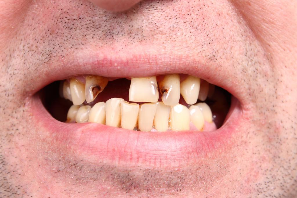 Что делать, если выпал зуб - сломал, проглотил | Способы восстановления зубов